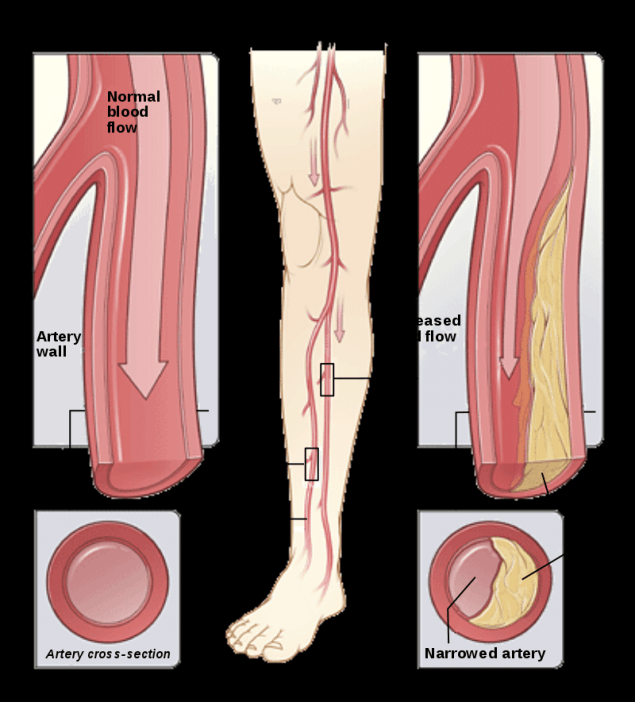 Peripheral Artery Disease (PAD) & Diabetic Foot Ulcer Treatment In Florida
