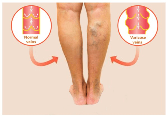 varicose veins legs