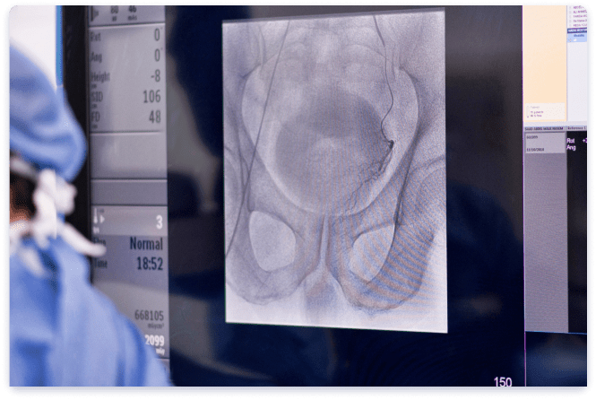 Prostatic Artery Embolisation - Vascular Health Center